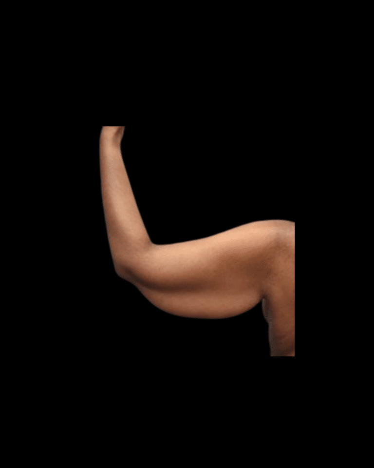 Before Image: Brachioplasty & Breast Augmentation (Implants) Patient #1 - front