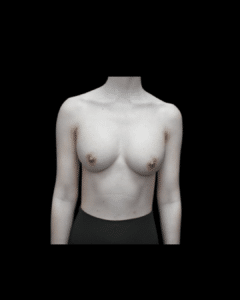 After Image: Breast Augmentation (Implants) Patient #19
