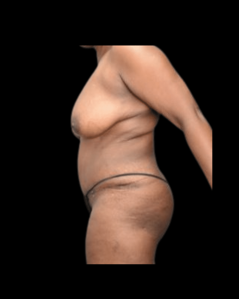 After Image: Abdominoplasty/Tummy Tuck Patient #11 - front