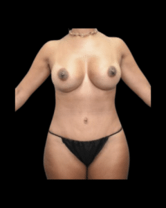 After Image: Abdominoplasty/Tummy Tuck Patient #12
