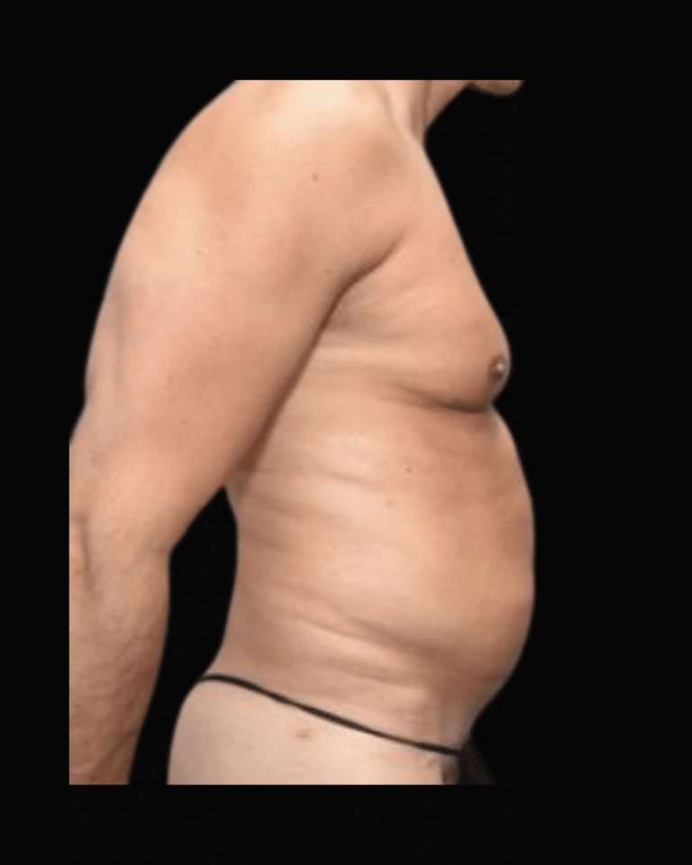 Before Image: Liposuction Patient #9 -
