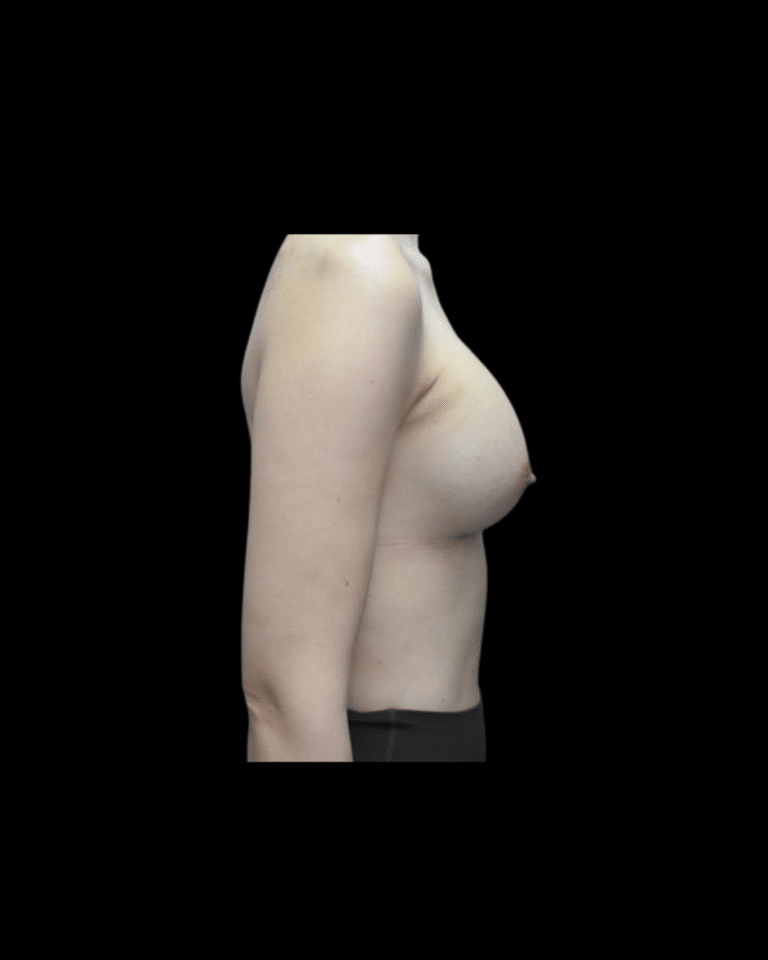 After Image: Breast Augmentation (Implants) Patient #19 -