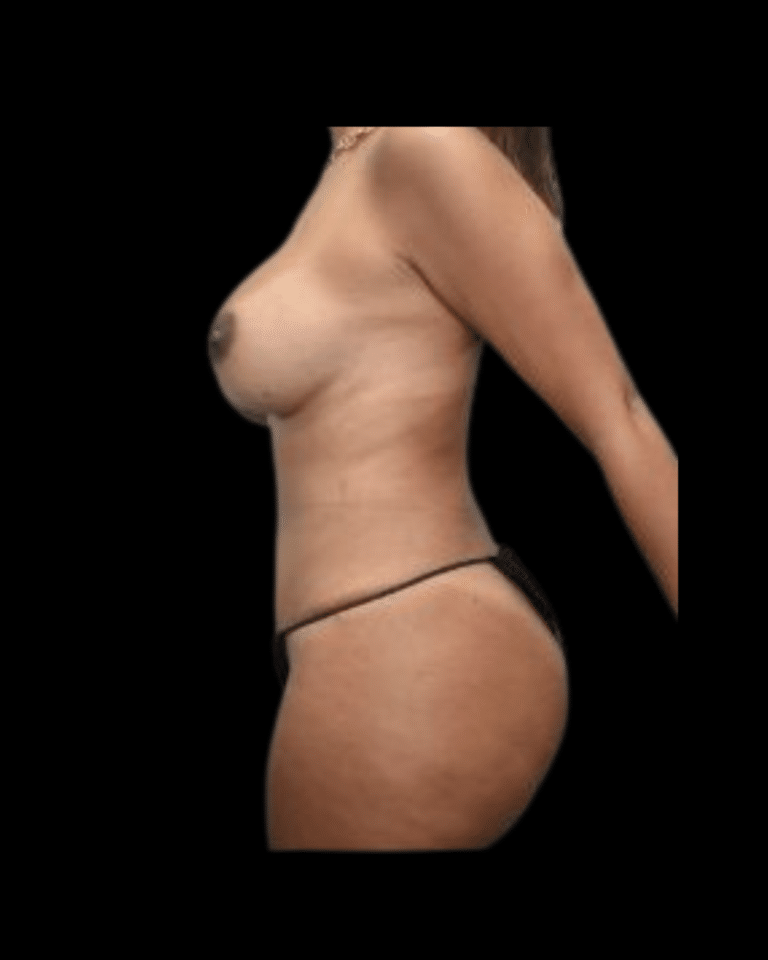 After Image: Abdominoplasty/Tummy Tuck Patient #12 - left-side