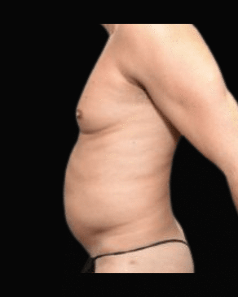 Before Image: Liposuction Patient #9 -