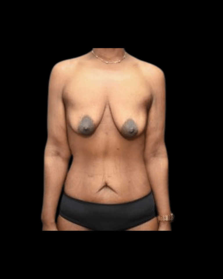 Before Image: Brachioplasty & Breast Augmentation (Implants) Patient #1 - front