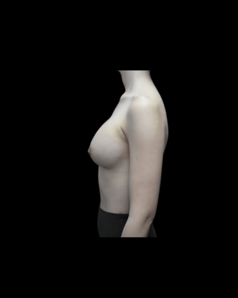 After Image: Breast Augmentation (Implants) Patient #19 -
