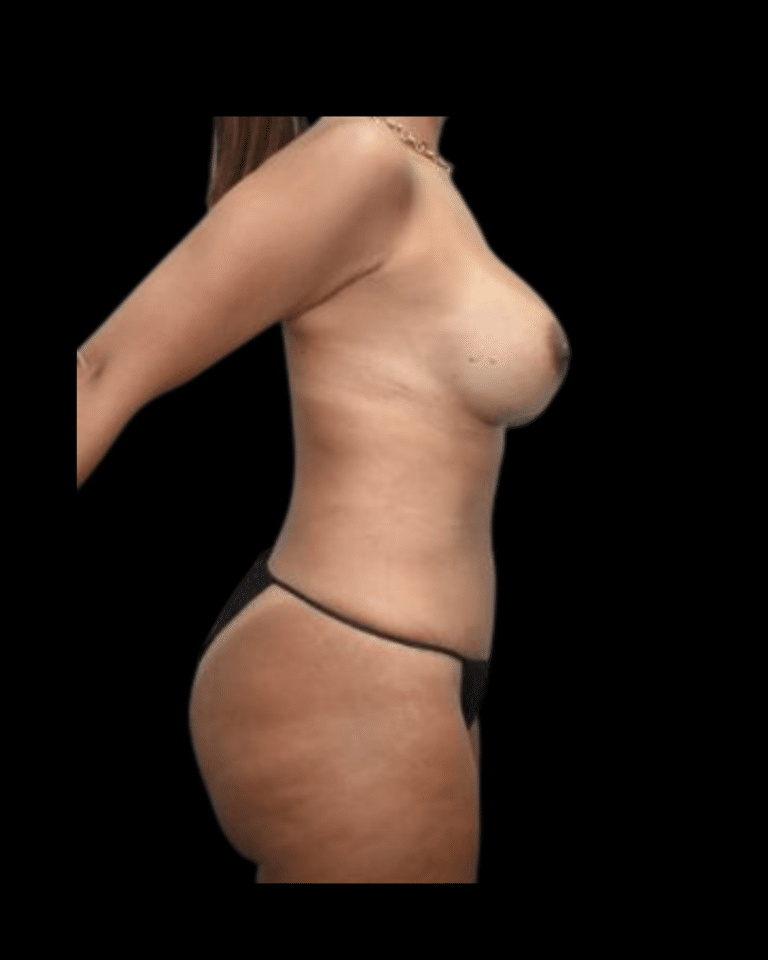 After Image: Abdominoplasty/Tummy Tuck Patient #12 - right-side