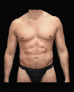 After Image: Liposuction Patient #9