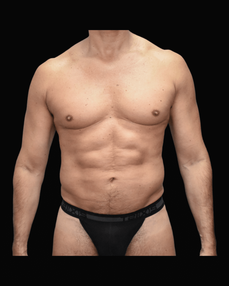 After Image: Liposuction Patient #9 - front