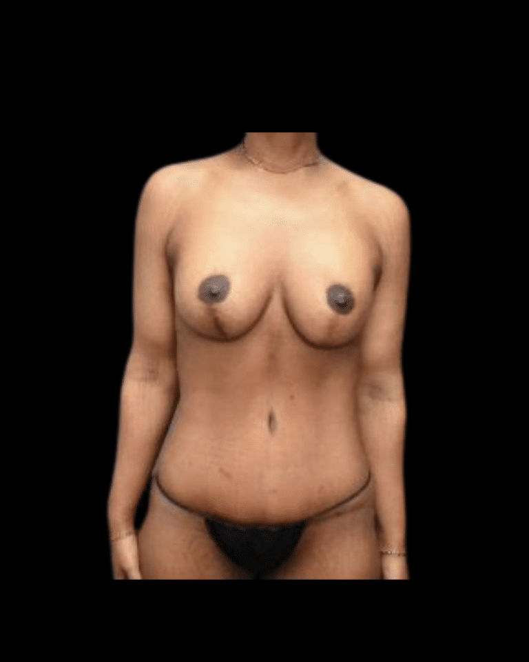 After Image: Brachioplasty & Breast Augmentation (Implants) Patient #1 - front
