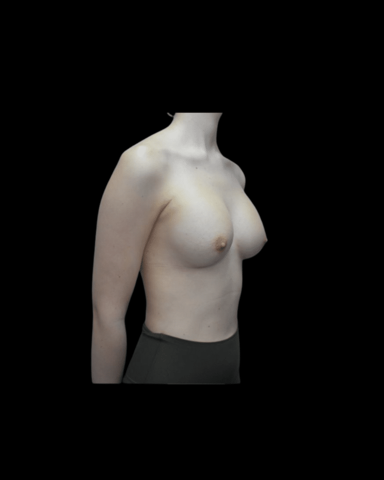 After Image: Breast Augmentation (Implants) Patient #19 -