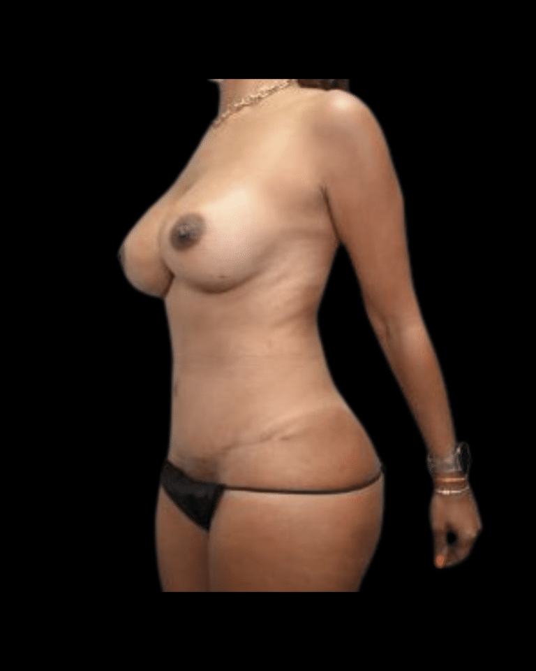 After Image: Abdominoplasty/Tummy Tuck Patient #12 - left-front-oblique