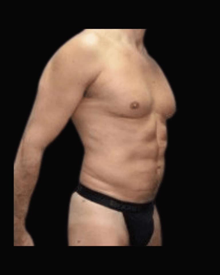 After Image: Liposuction Patient #9 -
