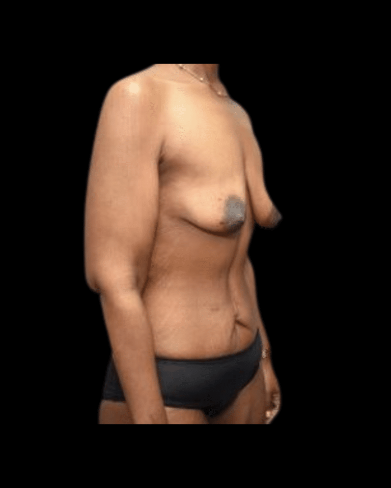 Before Image: Brachioplasty & Breast Augmentation (Implants) Patient #1 - front