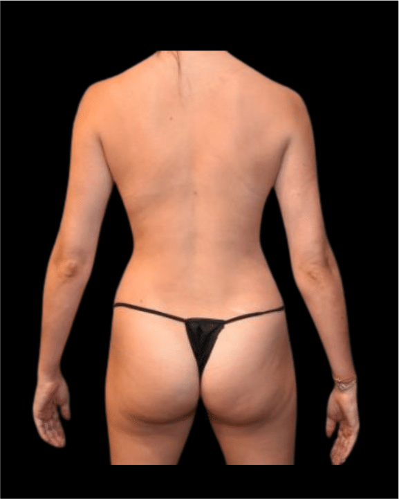 After Image: Breast Augmentation (Fat) Patient #5 - back