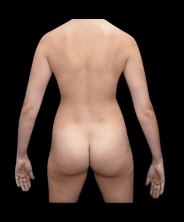 Before Image: Breast Augmentation (Fat) Patient #5 - back
