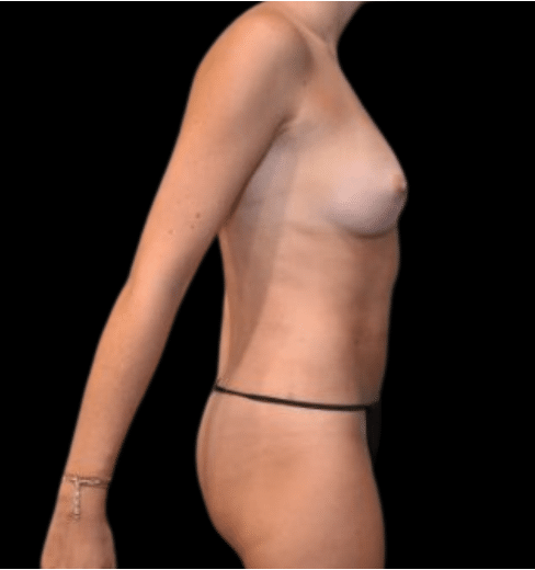 After Image: Breast Augmentation (Fat) Patient #5 - right-side