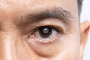 Close-up of a man's eye showing under-eye puffiness and lower eyelid bags, a common concern addressed with male blepharoplasty