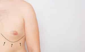 Male chest with markings indicating planned gynecomastia surgery for breast tissue removal