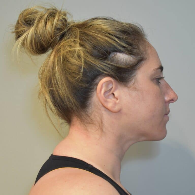 After Image: Submental Liposuction and J-Plasma Patient #1 - right-side