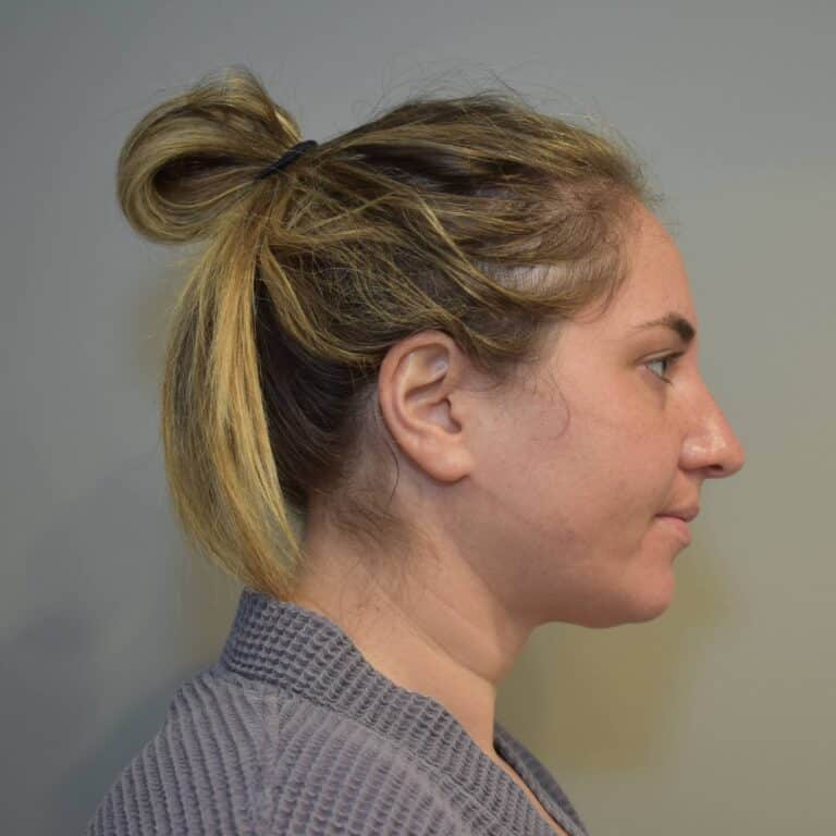 Before Image: Submental Liposuction and J-Plasma Patient #1 - right-side