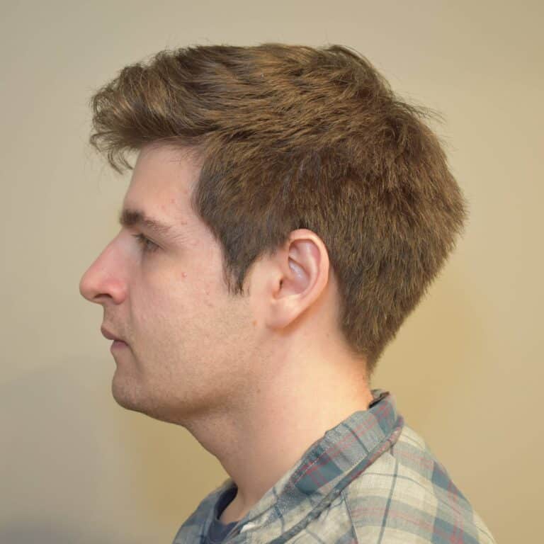 After Image: Submental & Jawline Liposuction and J-Plasma - left-side