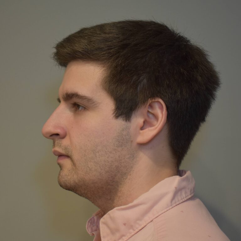 Before Image: Submental & Jawline Liposuction and J-Plasma - left-side