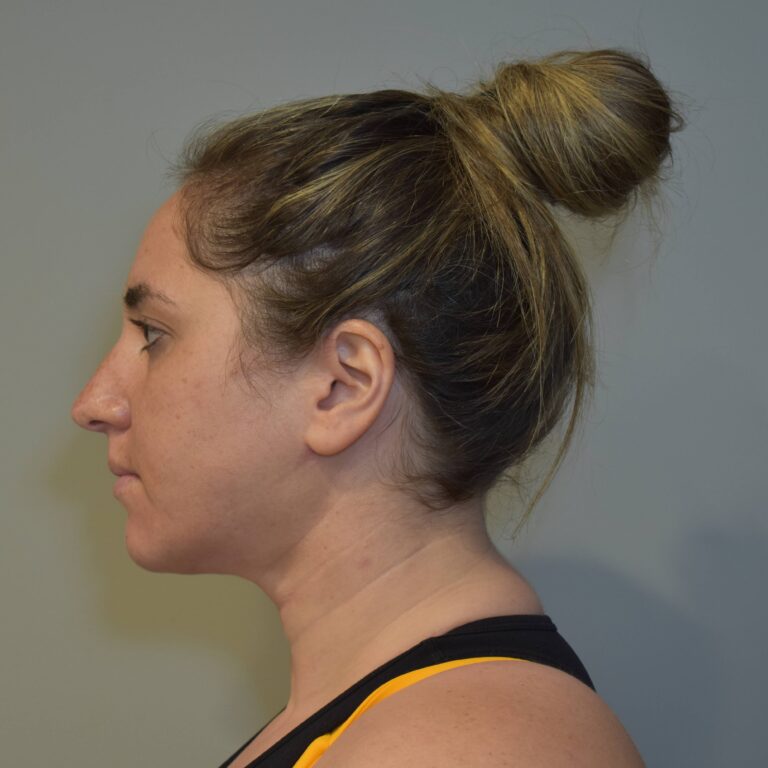 After Image: Submental Liposuction and J-Plasma Patient #1 - left-side