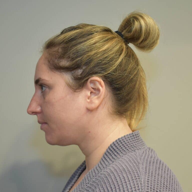 Before Image: Submental Liposuction and J-Plasma Patient #1 - left-side