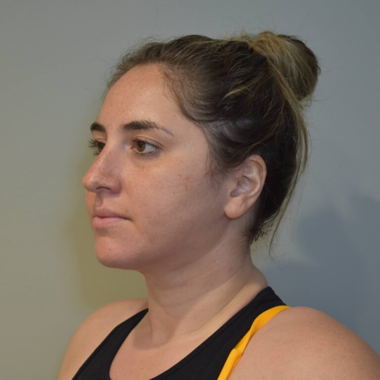 After Image: Submental Liposuction and J-Plasma Patient #1 - left-front-oblique