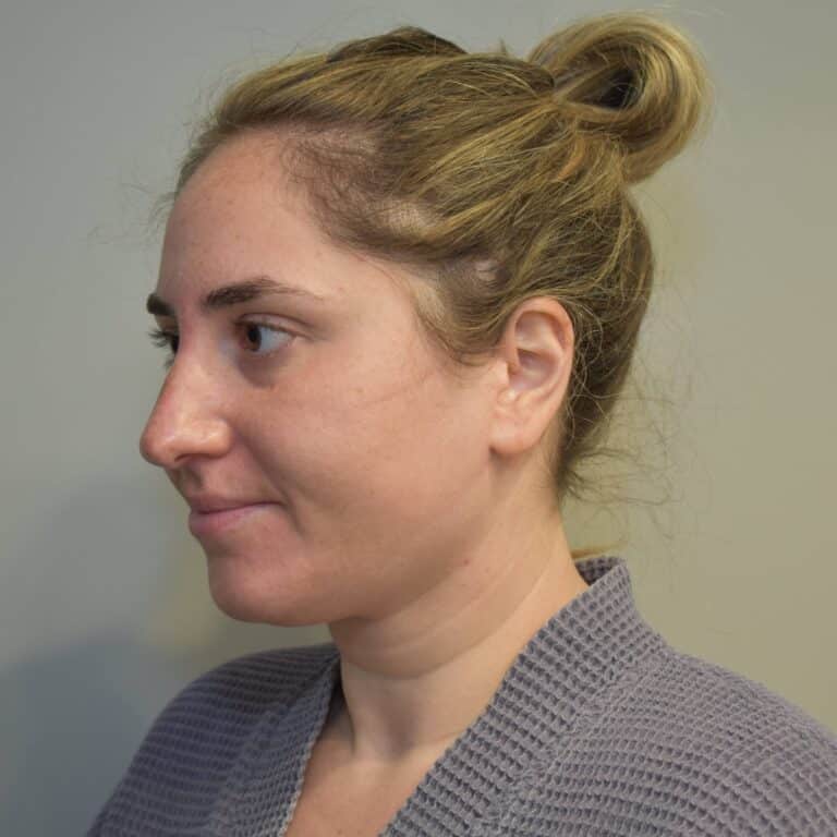 Before Image: Submental Liposuction and J-Plasma Patient #1 - left-front-oblique