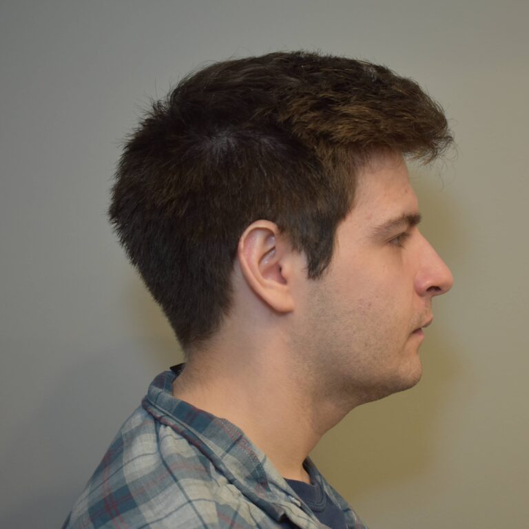 After Image: Submental & Jawline Liposuction and J-Plasma - right-side