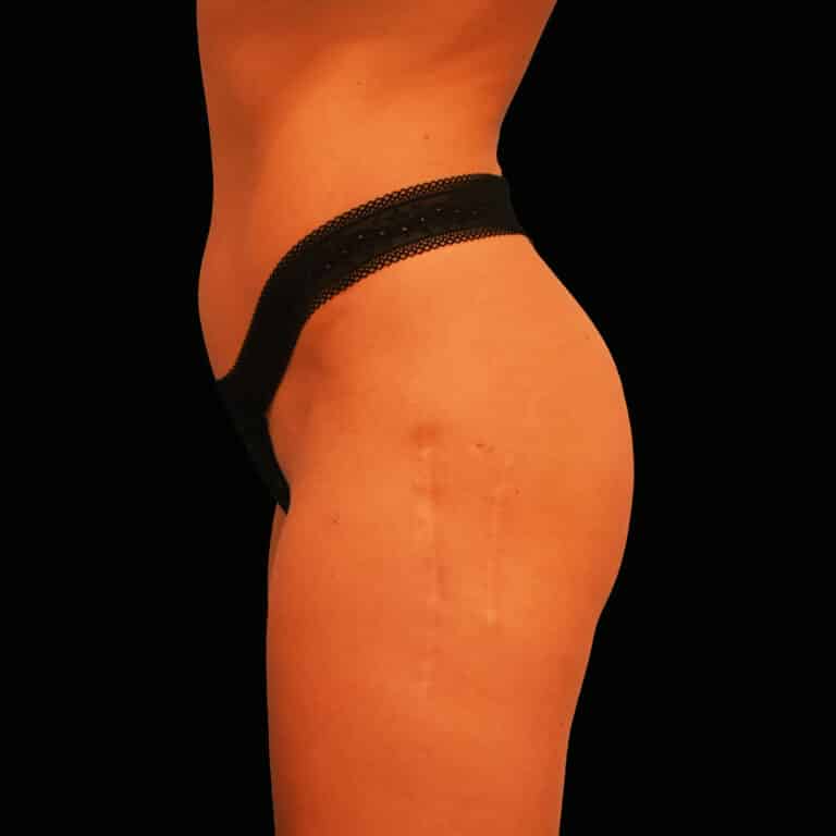 After Image: alloClae Patient #1 - left-side