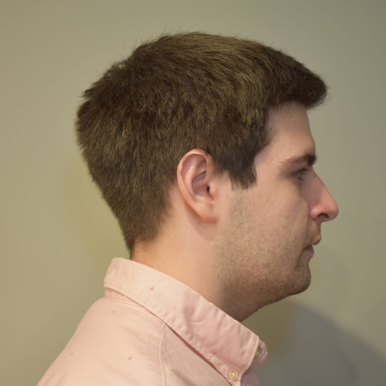 Before Image: Submental & Jawline Liposuction and J-Plasma - right-side