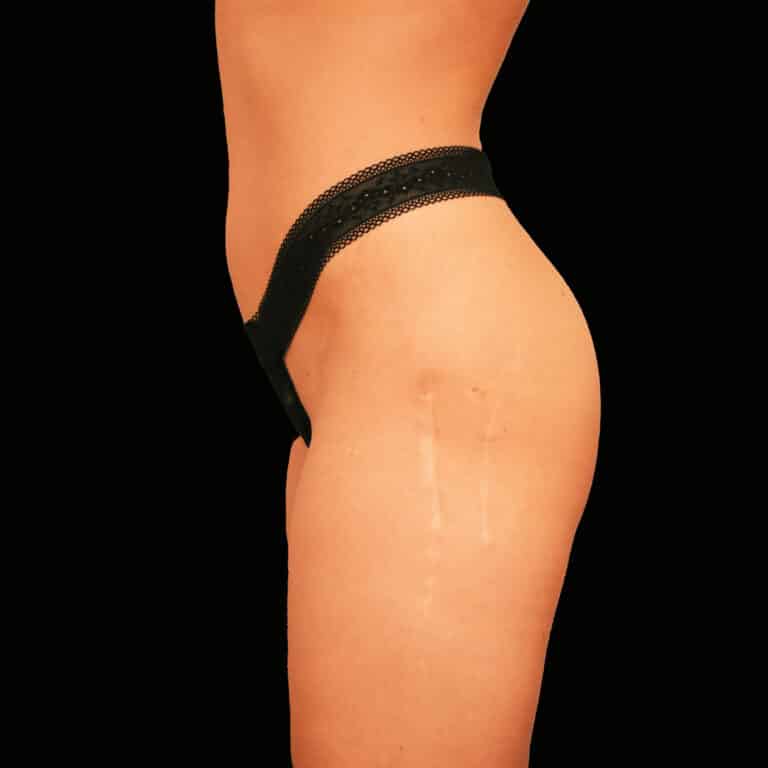 Before Image: alloClae Patient #1 - left-side