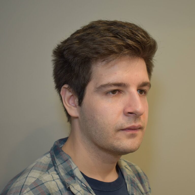 After Image: Submental & Jawline Liposuction and J-Plasma - right-front-oblique