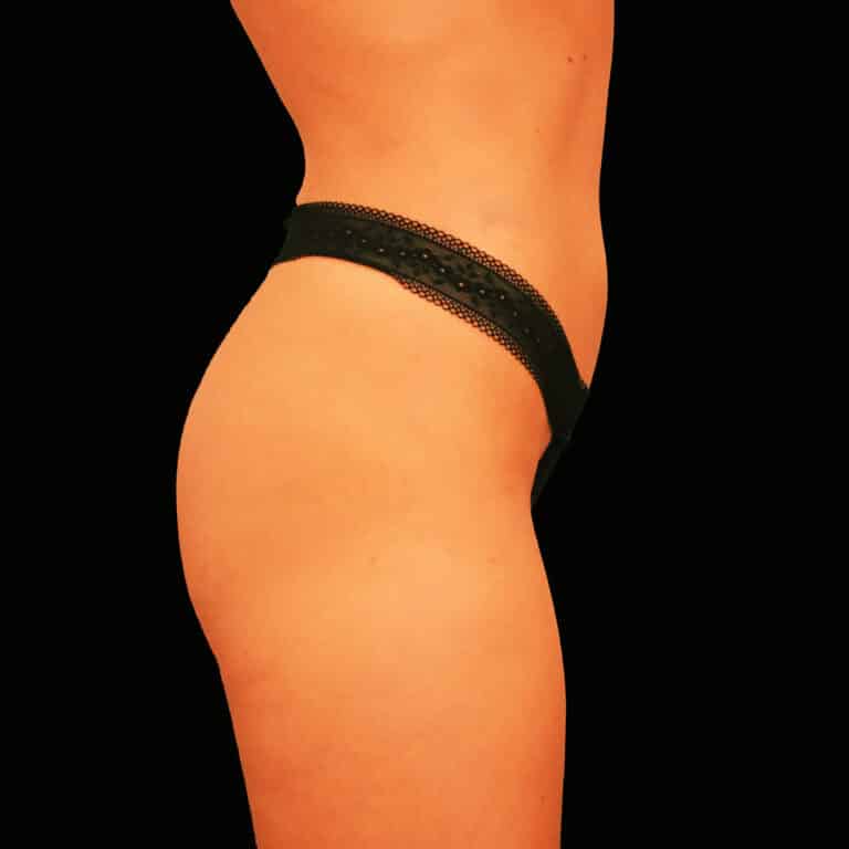 Before Image: alloClae Patient #1 - right-side