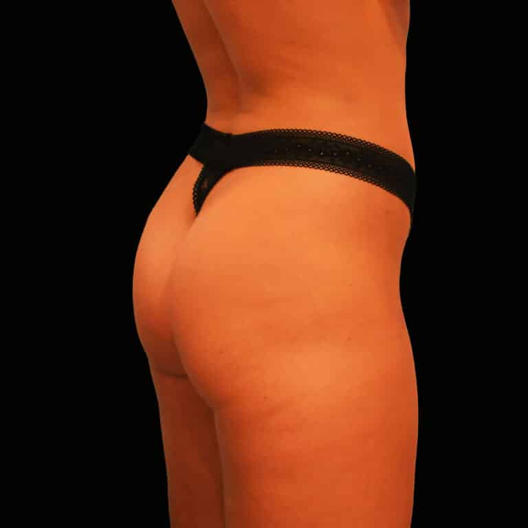 After Image: alloClae Patient #1 (Contd…) - right-back-oblique