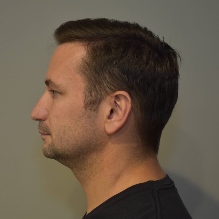 Before Image: Submental Liposuction and J-Plasma Patient #2 - left-side