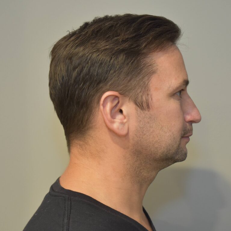Before Image: Submental Liposuction and J-Plasma Patient #2 - right-side
