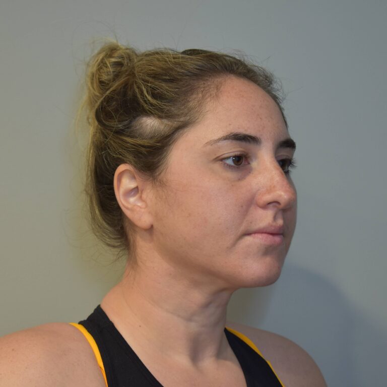 After Image: Submental Liposuction and J-Plasma Patient #1 - right-front-oblique