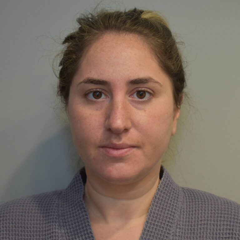 Before Image: Submental Liposuction and J-Plasma Patient #1 - front