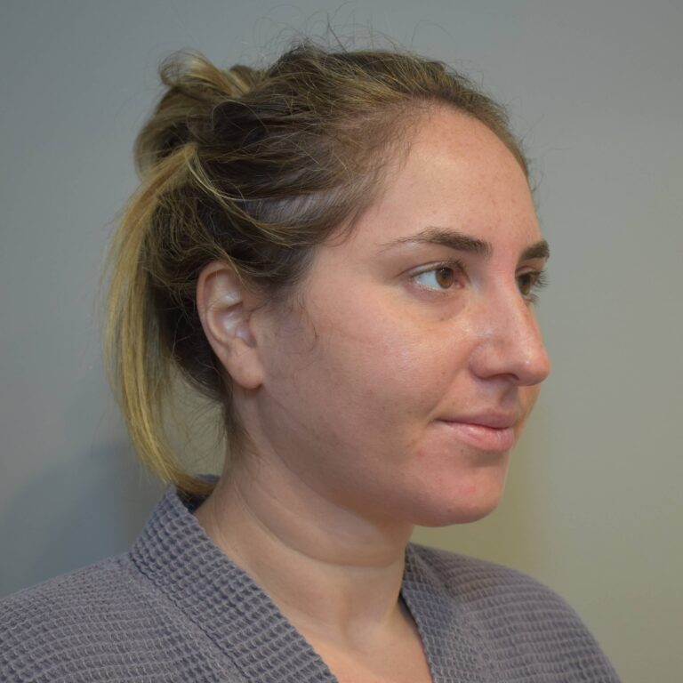 Before Image: Submental Liposuction and J-Plasma Patient #1 - right-front-oblique