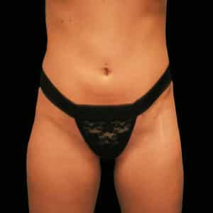 Before Image: alloClae Patient #1 (Contd…)
