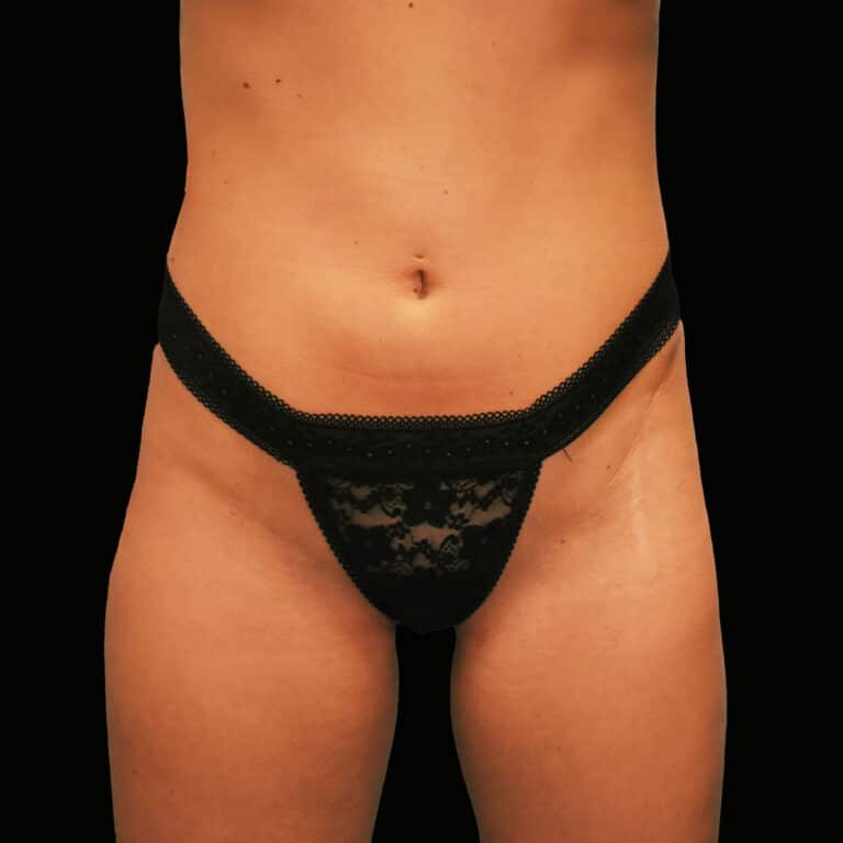 Before Image: alloClae Patient #1 (Contd…) - front
