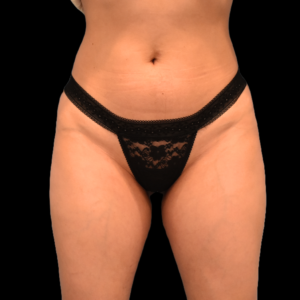 After Image: alloClae Patient #2