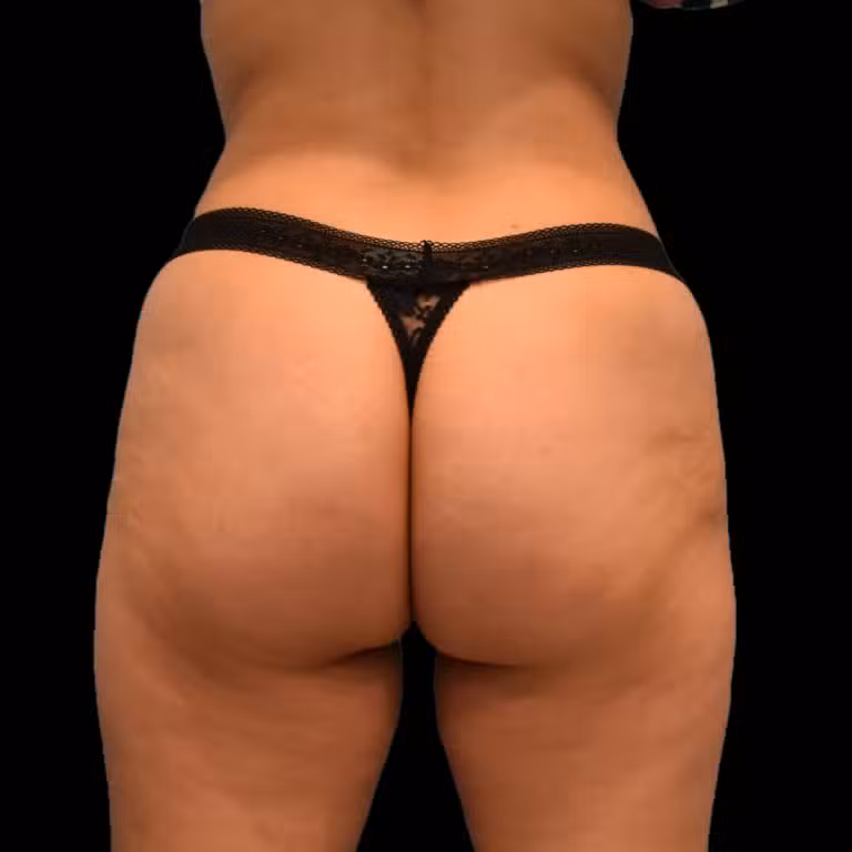 After Image: alloClae Patient #2 - back