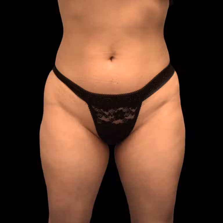 Before Image: alloClae Patient #2 - front