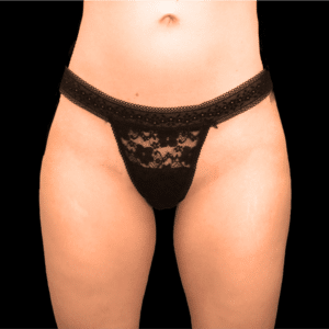 After Image: alloClae Patient #4