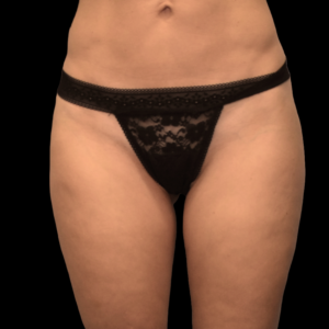 After Image: alloClae Patient #3